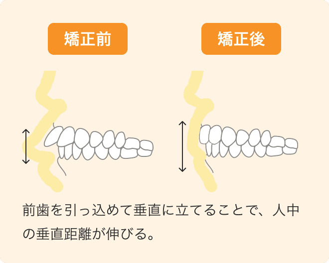 前歯を引っ込めて垂直に立てることで、人中の垂直距離が伸びる。
